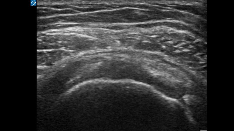mskshoulderpaincalctendosis1crop vimeo thumbnail