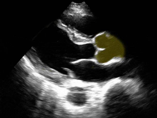 GUSI 1 Aortic outflow PSLA Colorized