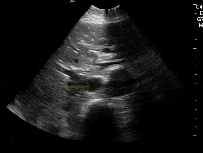 GUSI 136 Aorta Anatomy IVC Marked