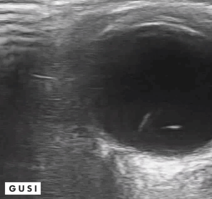 POCUS education eye opening ultrasound2