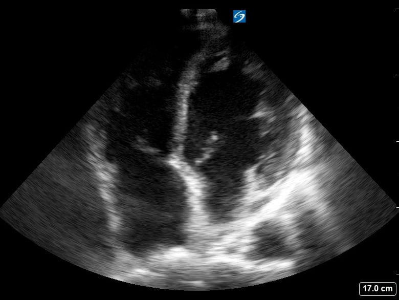 A4C Depressed Ef32 (Ef ~35%) - Video
