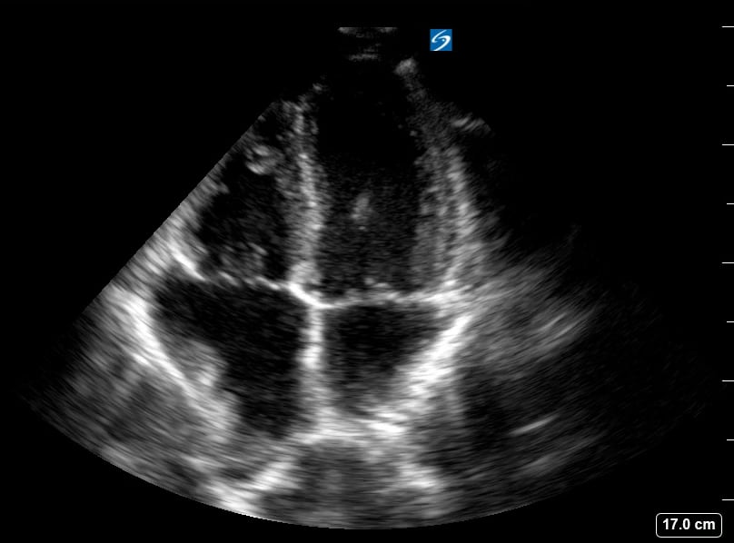 A4C Normal Ef4 (Moderator Band In Rv) - Video