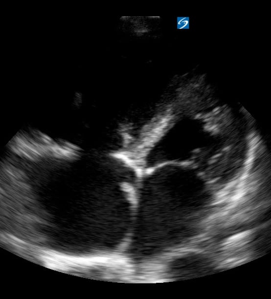 A4C R Heart Strain4 - Video