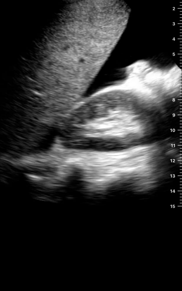 Ascites2 (Morrison’S Pouch) - Video