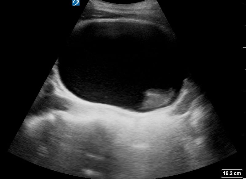 Bladder Hematoma3 - Video