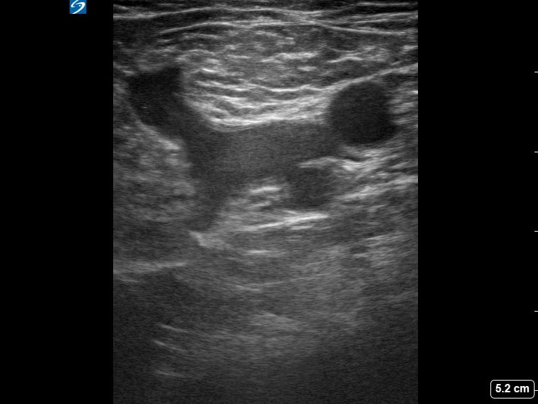 Femoral (-) Dvt22 (At Saphenous Junction) - Video