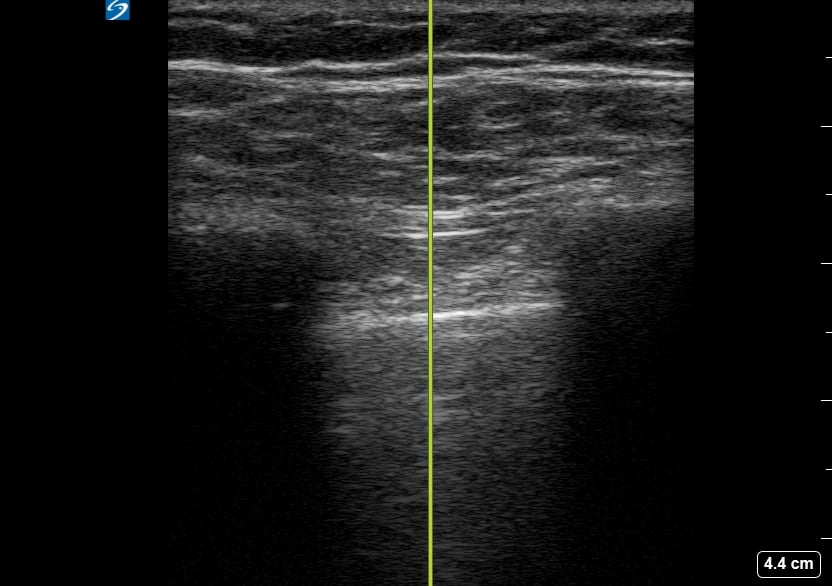 (-) Pneumothorax9 - Video