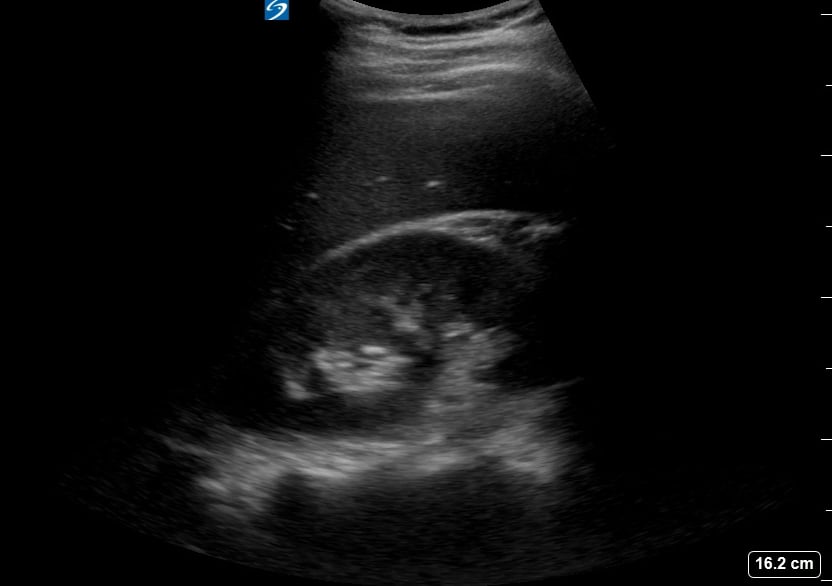 Ruq (-) Free Fluid14 - Video