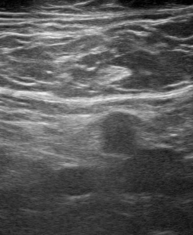 Femoral (-) Dvt20 - Video