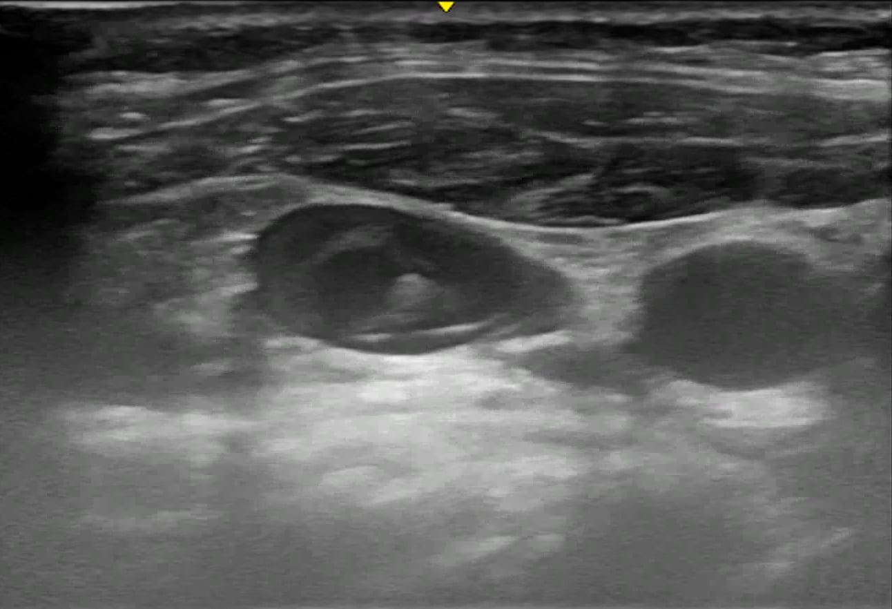 DVT: Present - Video