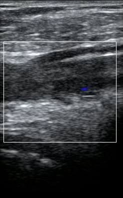 DVT: Present - Video