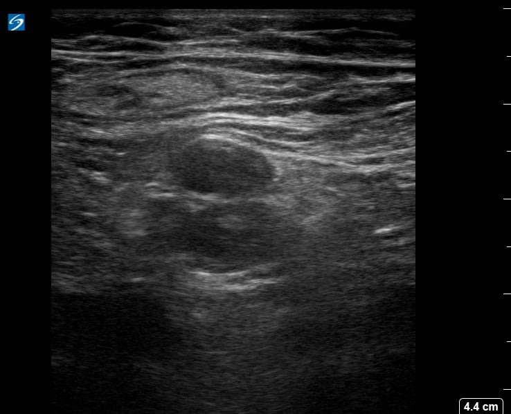 Femoral Dvt11 - Video
