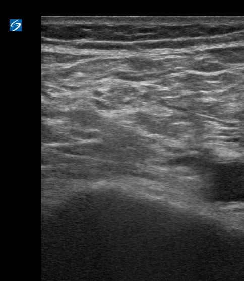 Femoral (-) Dvt26 - Video