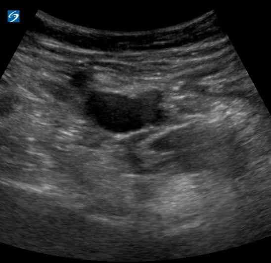 Femoral (-) Dvt25 (At Saphenous Junction) - Video