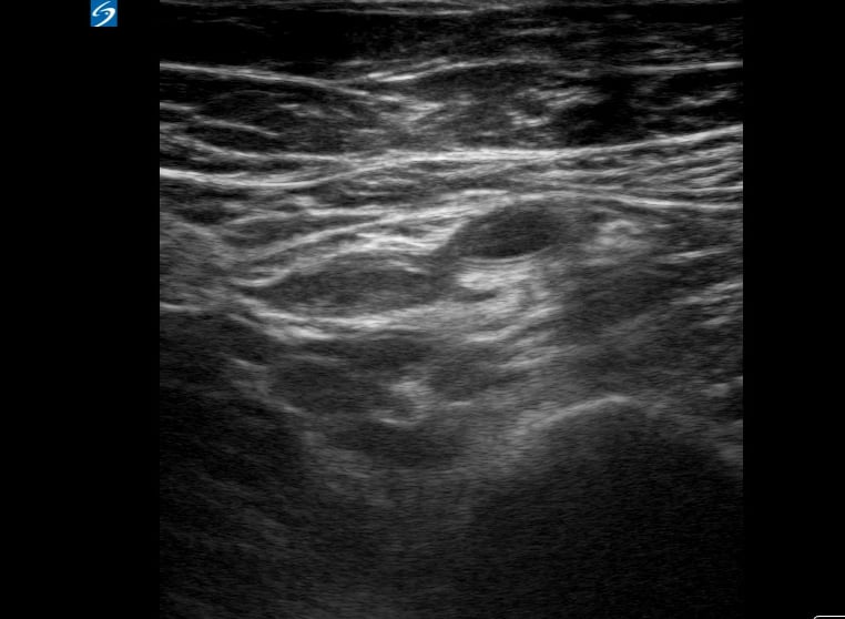 Femoral Dvt6 - Video