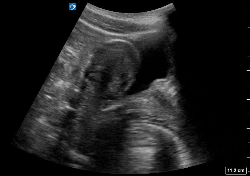 Pelvic (-) Free Fluid5 - Video