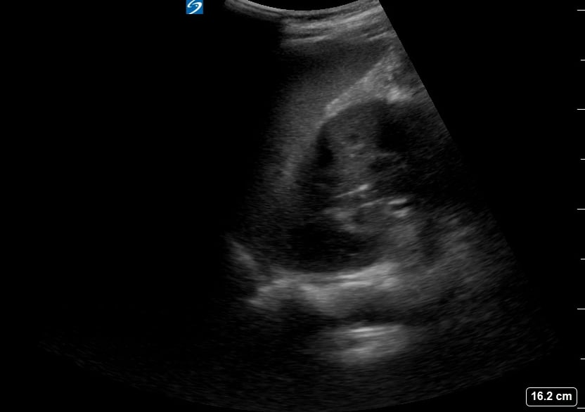 Ruq (-) Free Fluid1 - Video