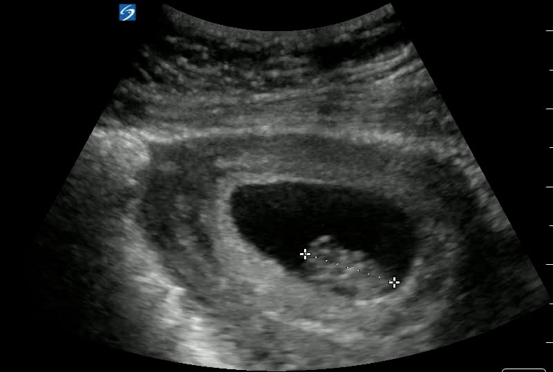 Gestational Sac Global Ultrasound Institute