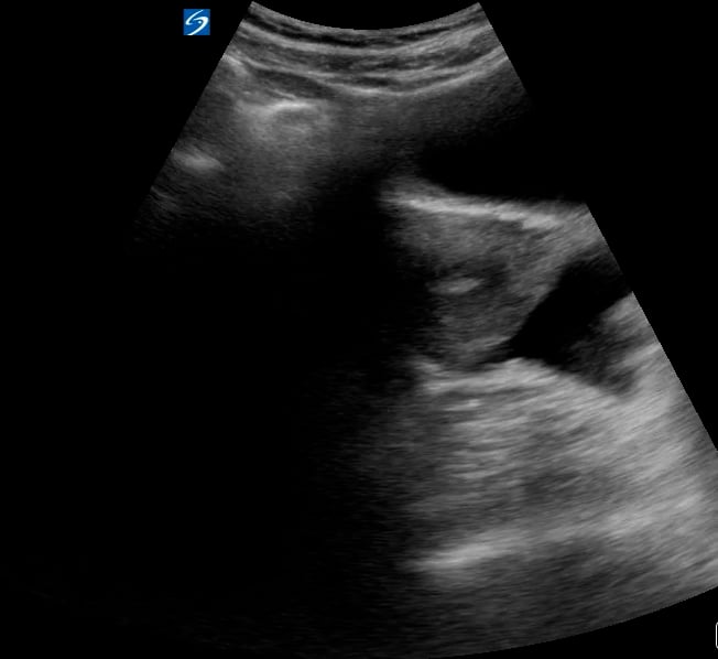 Free Fluid: Present - Video