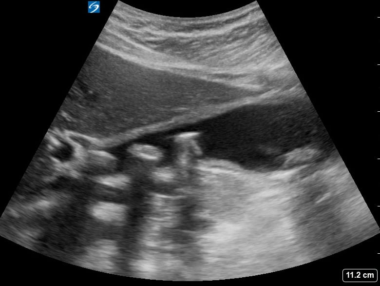Multiple Gallstones + Cholecystitis3 (+Sono Murphy’S) - Video