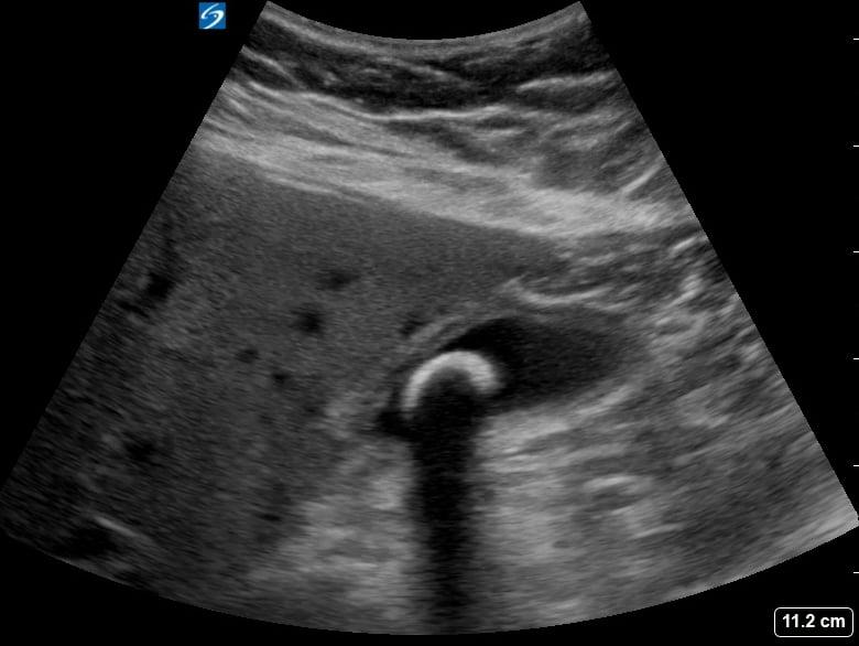Large Gallstone + Cholecystitis5 (+Sono Murphy’S