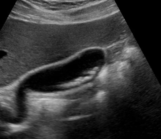 Multiple Gallstones + Cholecystitis1 (+Sono Murphy’S) - Video