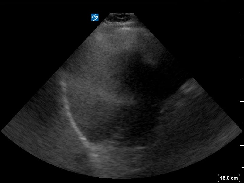 Multiple Gallstones11 - Video