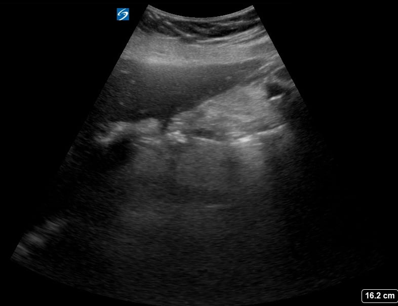 Multiple Gallstones15 (Contracted Gb) - Video