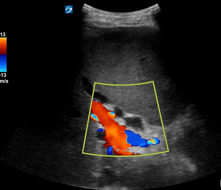 Dilated Cbd3 (Dilated To 13Mm