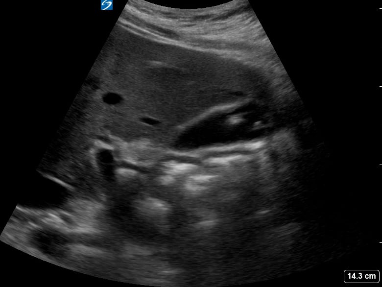 Multiple Gallstones4 - Video