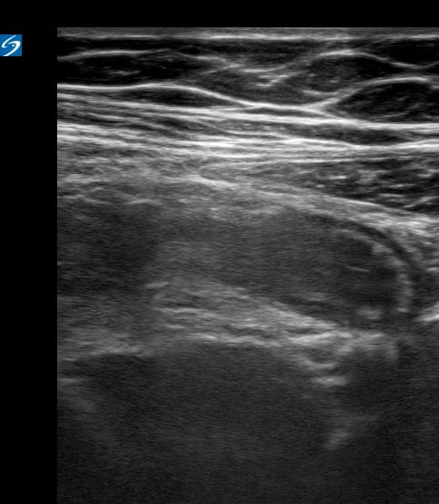 Appendicitis4 - Video