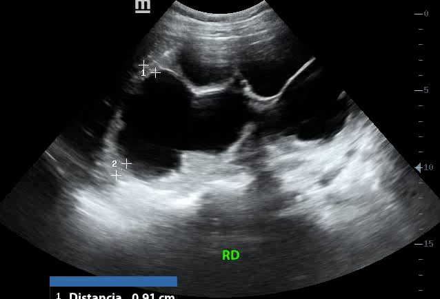 objects: Hydronephrosis - Video
