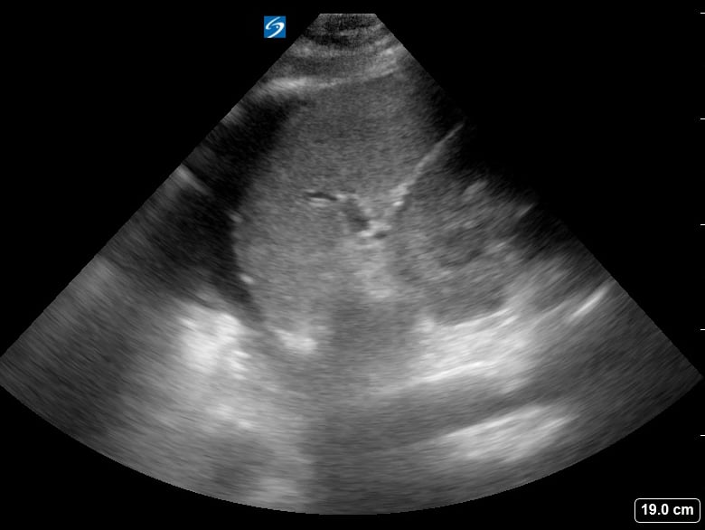 Pleural Effusion11 (+Spine Sign