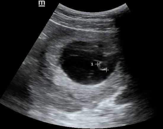 Intrauterine Gestational Sac: Present