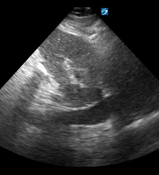 Plethoric Ivc8 (> 2.5Cm