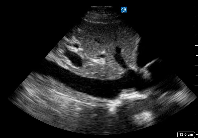 Plethoric Ivc17 (> 2.5Cm