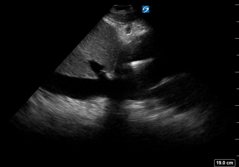 Plethoric Ivc26 (< 50% Collapse) - Video