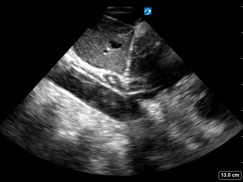 Plethoric Ivc18 (< 50% Collapse