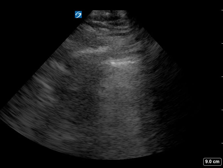 B Lines11 (+Subpleural Consolidation) - Video