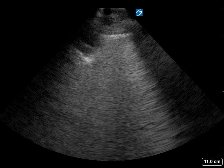 B Lines8 (+Subpleural Consolidation) - Video