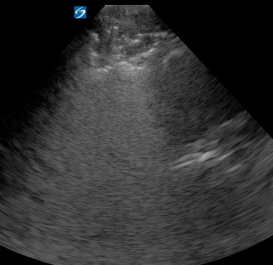 Hepatization5 (+Air Bronchograms) - Video
