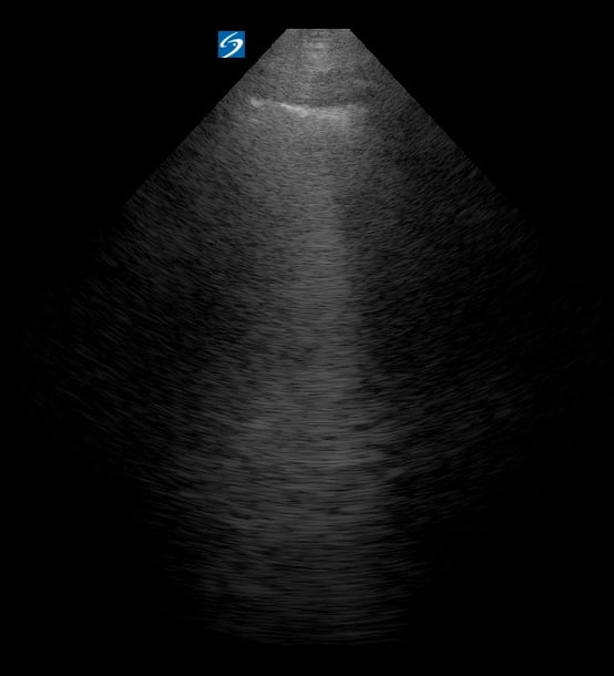 Pleural Irregularitis + B Lines2 - Video