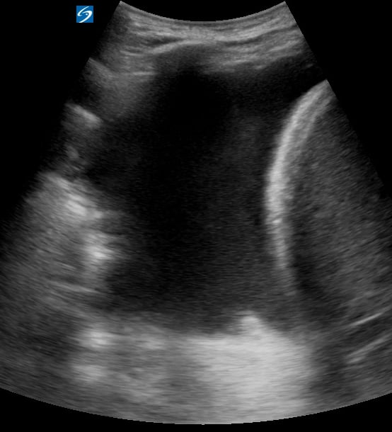 Pleural Effusion + Consolidation6 (With Air Bronchograms