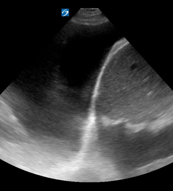 Pleural Effusion2 (+Spine Sign) - Video