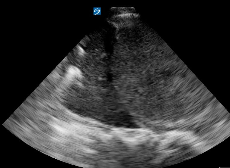 Hepatization With Pleural Effusion2 (+Spine Sign