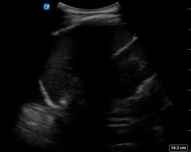 Luq (-) Pleural Effusion12 - Video