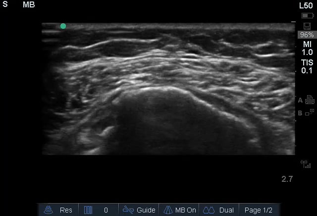 Massive Rotator Cuff Tear2 (Short Axis) - Video