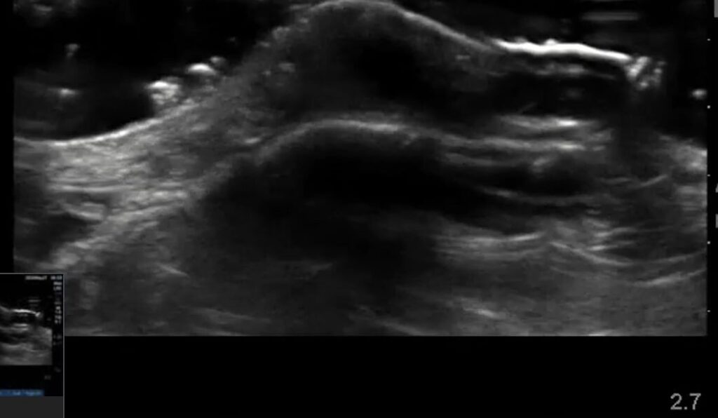 Medial Malleolus Bursitis1 - Video