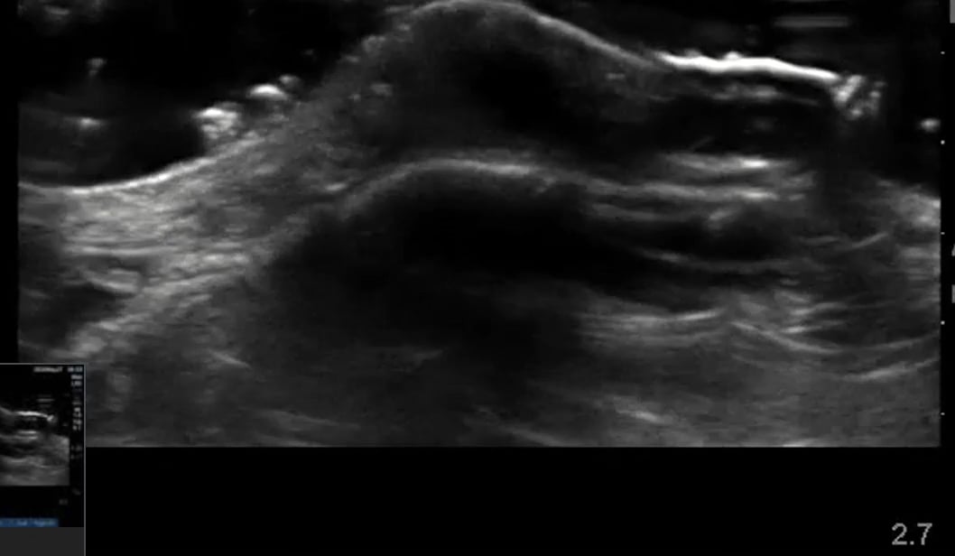 Medial Malleolus Bursitis1 - Video