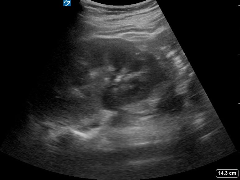 Mild Hydronephrosis